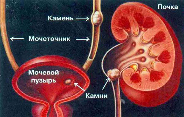 Камені в нирках: лікування народними засобами