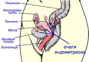 Ендометріоз: лікування народними засобами