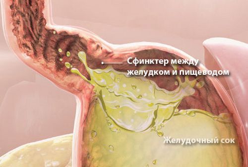 Що робити, якщо замучила печія