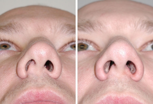 Як лікувати викривлення носової перегородки: операції, лазерне виправлення