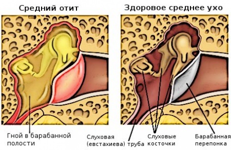 Як лікувати отит в домашніх умовах?
