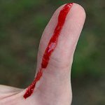 Перша медична допомога при кровотечах Перша медична допомога при кровотечах